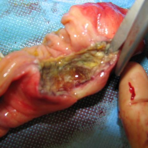 Amazing Mucus In Stool Diverticulitis  Don t miss out 