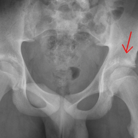 A postraumatic lesion of the pelvis | Eurorad