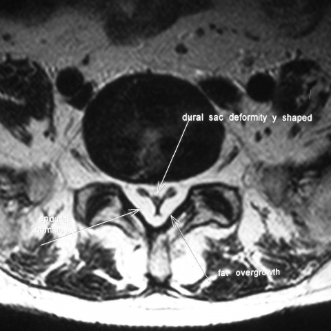 Spinal Epidural Lipomatosis | Eurorad