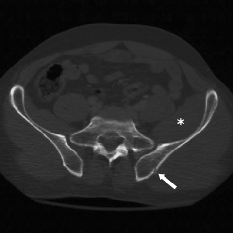 Inferior lumbar triangle, Radiology Reference Article