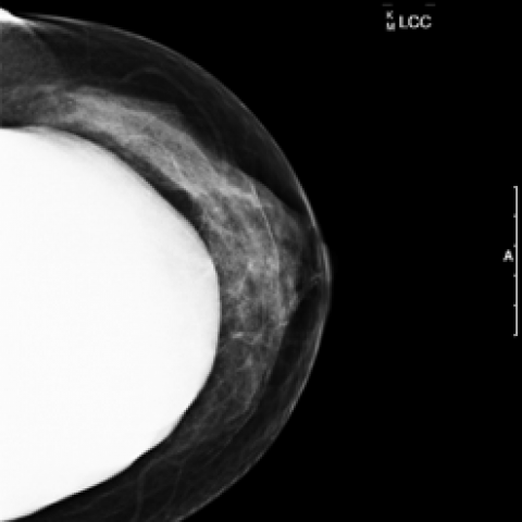 Mammogram With Breast Implants