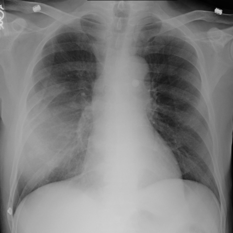 Non-Hodgkin\'s Lymphoma presenting as a chest wall mass | Eurorad
