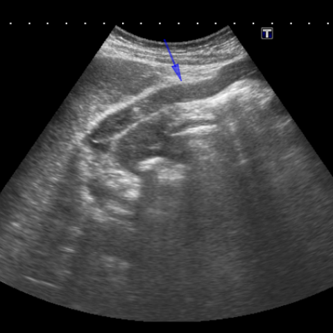 paraumbilical vein ultrasound