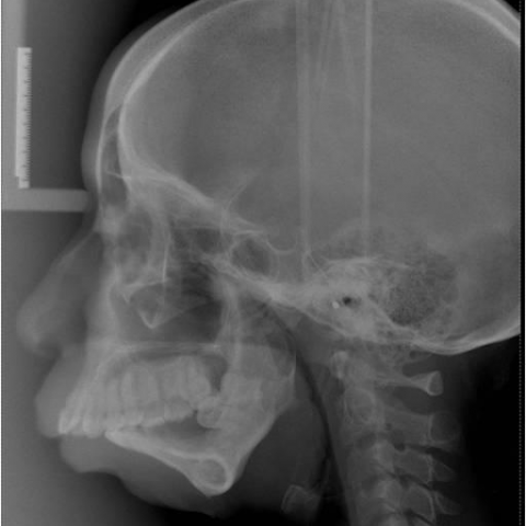 Actinomycosis of the mandible, possibly related to oral cavity or ...