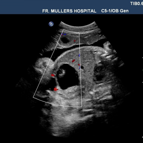 fetal cysts ultrasound