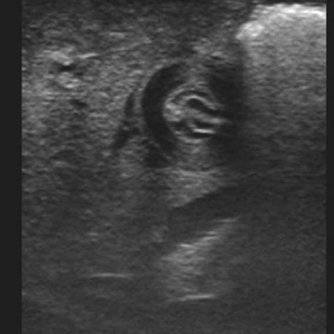 US evaluation of infantile hypertrophic pyloric stenosis before and ...
