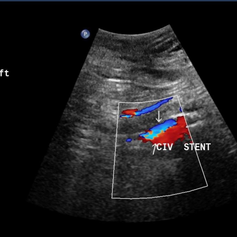 ultrasound of leg veins