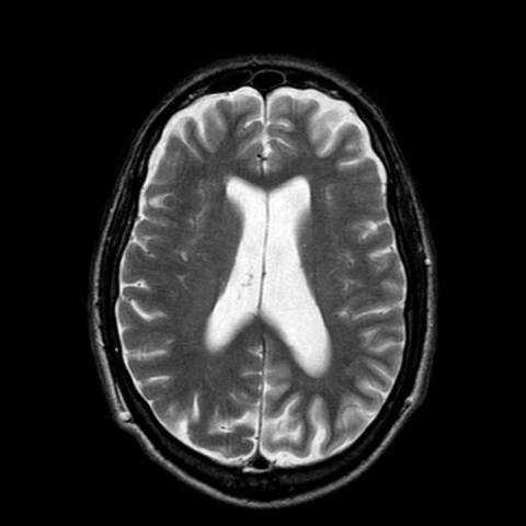 MRI & Creutzfeldt-Jakob Disease; 3 Cases demonstrating the variety of ...
