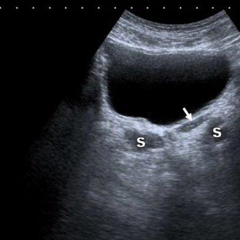Findings suggestive of ejaculatory duct obstruction during ...