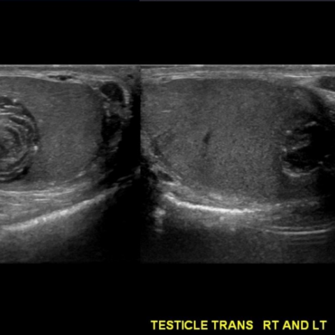 testicular epidermoid cyst