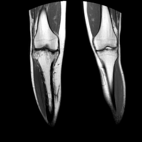 Cortical fracture and procurvatum deformity in a Pagetic tibia | Eurorad