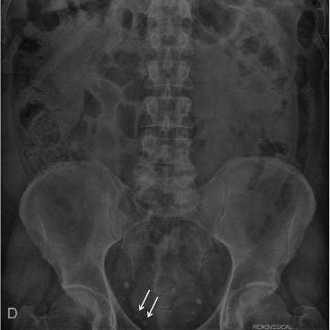 pelvis eurorad spontaneous caused urolithiasis rupture calyceal calcifications presenting relative projected radiolucent centere phleboliths