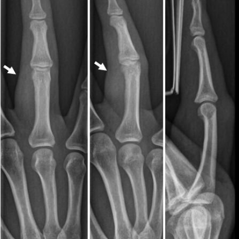 Fibrosseous pseudotumour of the digit (FOPD): non-calcified radiologic ...