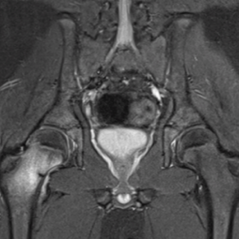 Femoral neck stress fracture in an adolescent boy | Eurorad