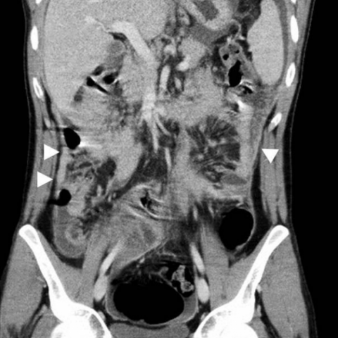 Prostate cancer in a 75-year-old man. CT image demonstrates omental... |  Download Scientific Diagram