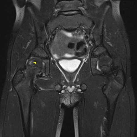 Sciatic nerve palsy complicating posterior hip dislocation in a child ...