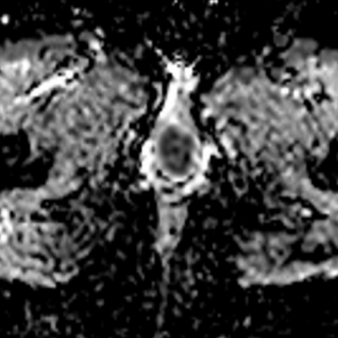 Peripheral primitive neuroectodermal tumour (PNET) of the vulva | Eurorad