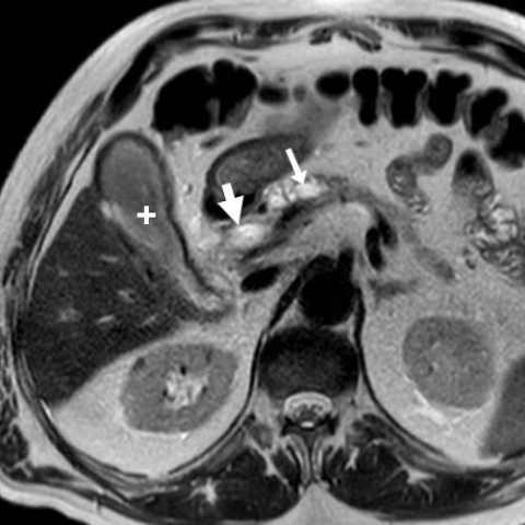 pancreatic dilated mrcp eurorad mpd contained gallbladder predominantly weighted atrophied forming pancreatitis