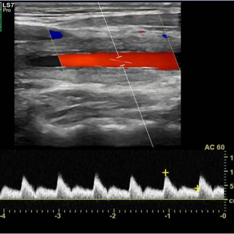 Imaging of vascular inflammation with ultrasound | Eurorad