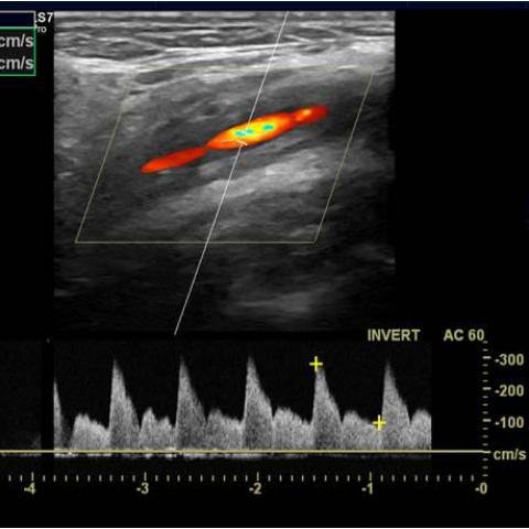 Imaging of vascular inflammation with ultrasound | Eurorad