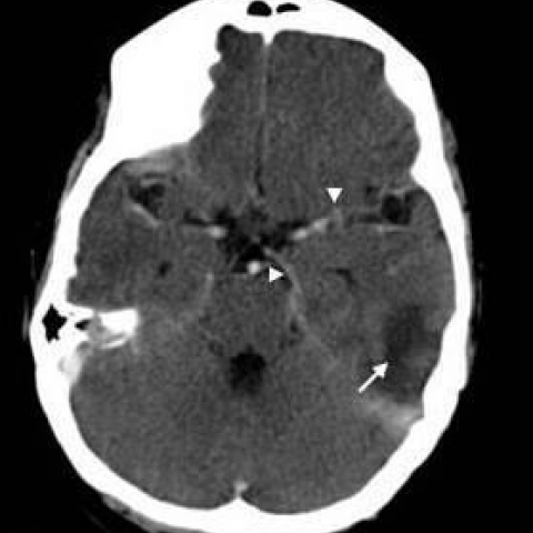Cerebral venous thrombosis in a young female patient with ...