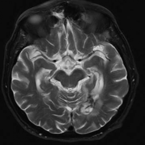 Metronidazole-induced encephalopathy: Case report and literature review ...