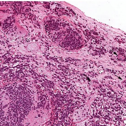 Olfactory Neuroblastoma | Eurorad