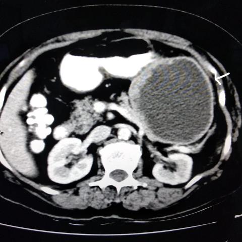CT imaging features of abdominal (mesenteric) desmoid tumour | Eurorad