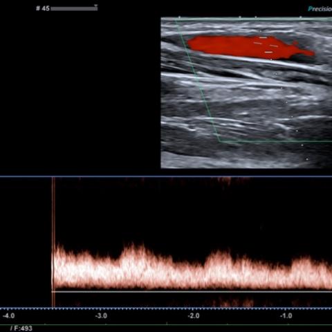 Radial arteriovenous fistula after cardiac catheterisation | Eurorad