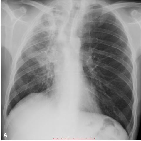 Necrotising pneumonia and septic shock due to Klebsiella pneumoniae ...