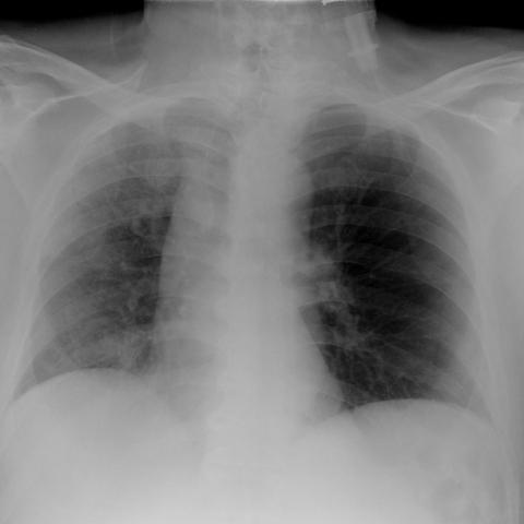 Pneumothorax and pneumomediastinum: a rare complication in the ...