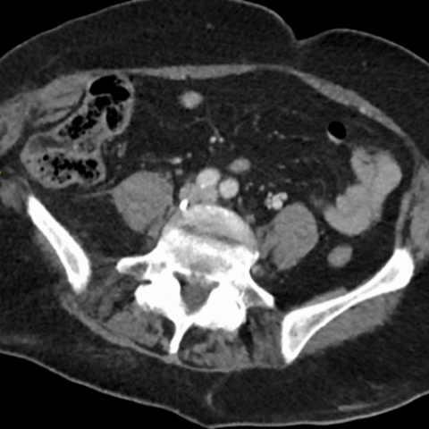 Abdominal CT scan: fracture of the left iliac crest (arrow)