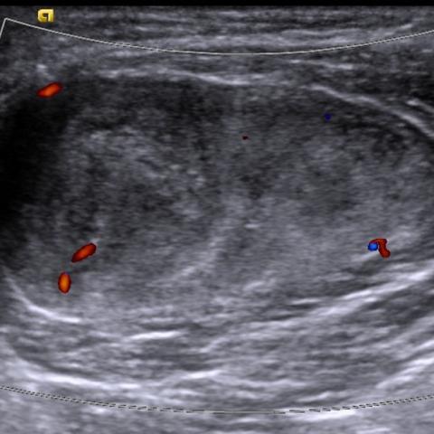 Synovial Sarcoma in Upper Extremity in an Adolescent Boy | Eurorad