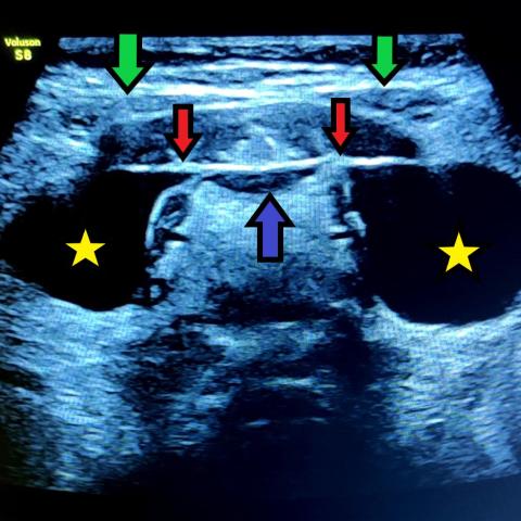 ranula ultrasound