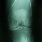 AP Radiograph of Left Knee