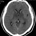 cranial CT scan