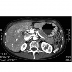 Contrast-enhanced CT: pancreatic phase