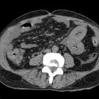 Thickened small bowel in the left lower quadrant with small amount of free intraperitoneal fluid