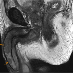 MRI study exhibiting multiple metastatic penile lesions: Sagittal T2-weighted image showing several intermediate signal intensity penile lesions.