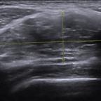 Ultrasound revealed a hyperechogenic, well-circumscribed solid mass with a diameter of 6 cm, located retroclavicular and ante