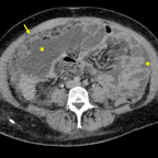 Axial contrast-enhanced abdominal CT scan shows irregular nodular thickening of the peritoneum, marked nodular thickening of the omentum, omental cake (arrow), and loculated ascites (asterisks).